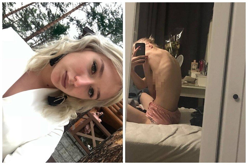    В погоне за идеалом стройности сибирячка едва не довела себя до истощения. Фото: из личного архива героини публикации