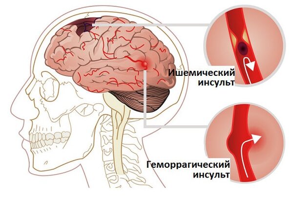 Признаки инсульта, которые помогут среагировать быстро