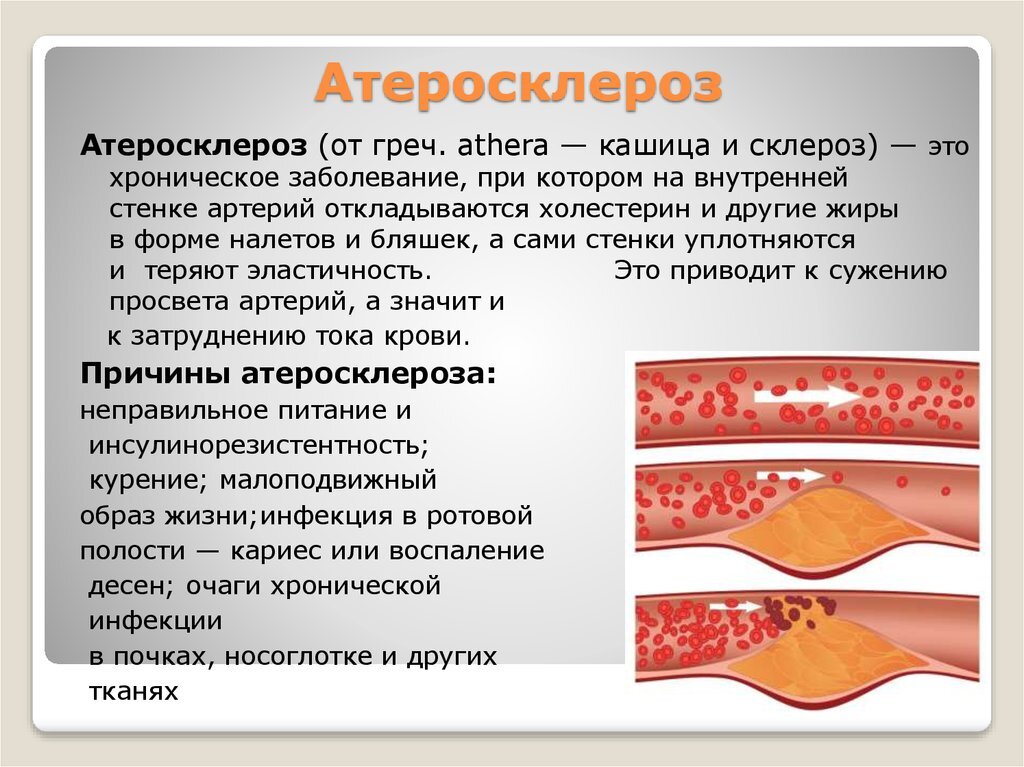 Как очистить кровеносные сосуды в домашних условиях