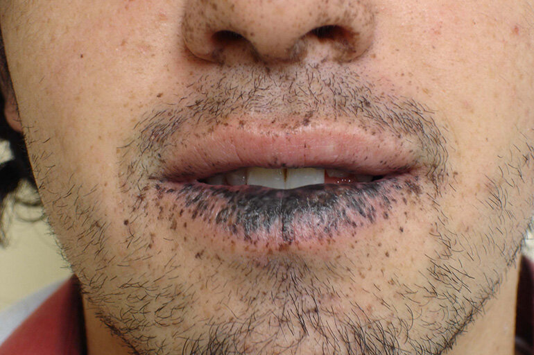 Синдром Пейтца-Егерса - редкое наследственное генетическое заболевание.