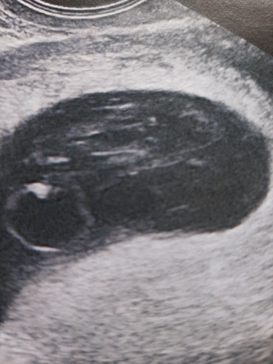 Сердцебиение отсутствует. Сам эмбрион имеет размытые очертания. Желточный мешок тоже деформирован. Фото любезно предоставлено кафедрой лучевой диагностики.