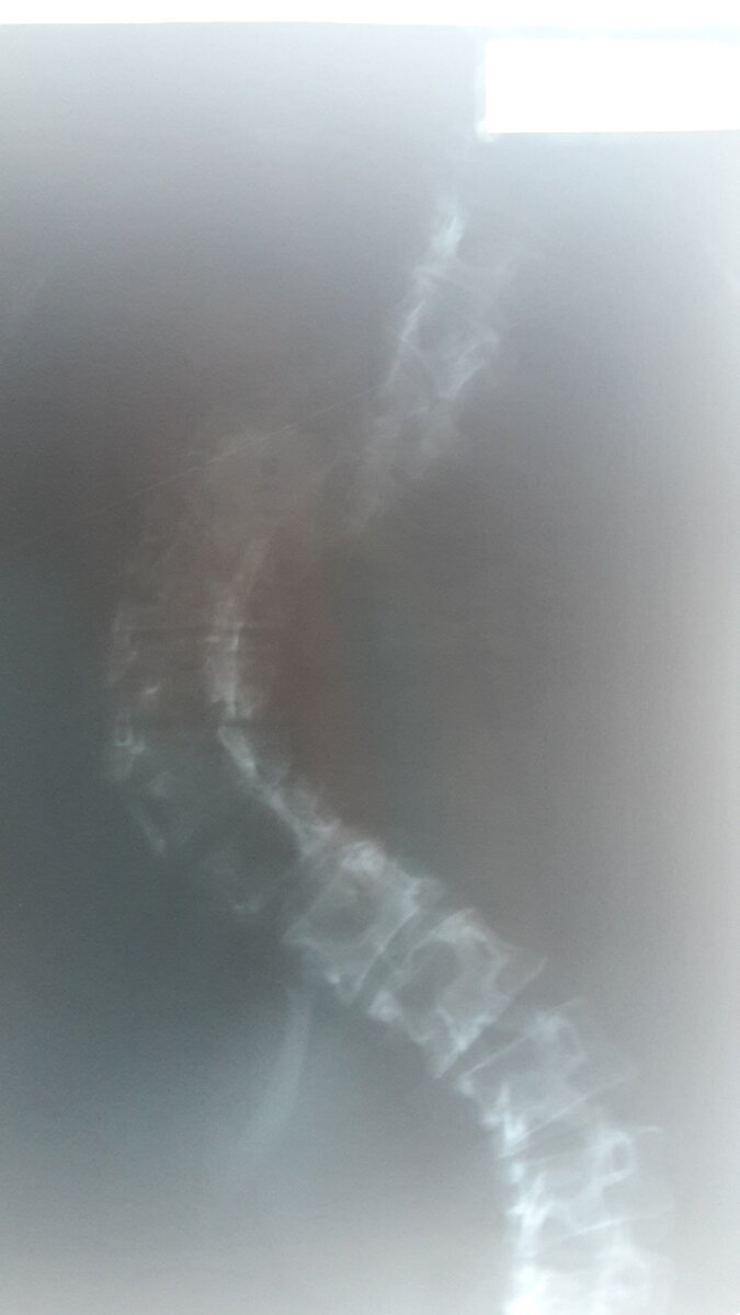 Сколиоз 4 степени на снимке