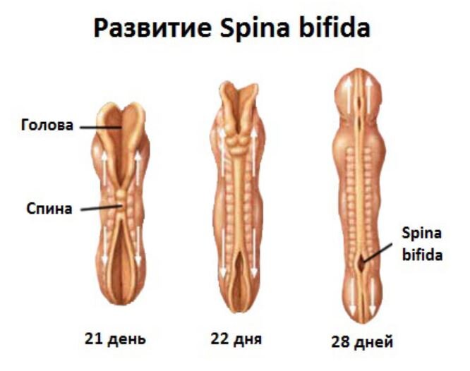 На картинке в целом понятно. Дни - возраст эмбриона. Дефект возникает в 3-4 недели - на этапе, когда из нервной трубки формируются зачатки ребенка. При формировании нервной трубки на уровне позвоночника остаются незакрытые бреши - иногда большие, чуть ли не с позвонок, а иногда - совсем маленькие. Как у меня)