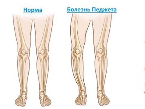 Остеопороз. Лечение остеопороза