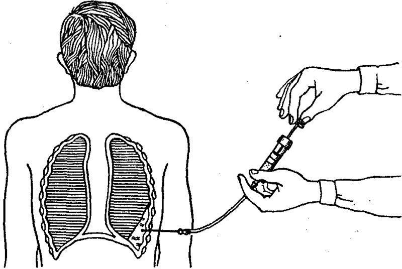 Пункция полостей. Пункция плевральной полости техника. Диагностическая пункция плевральной полости. Плевральная пункция 2 межреберье. Пункция плевральной полости при эмпиеме.