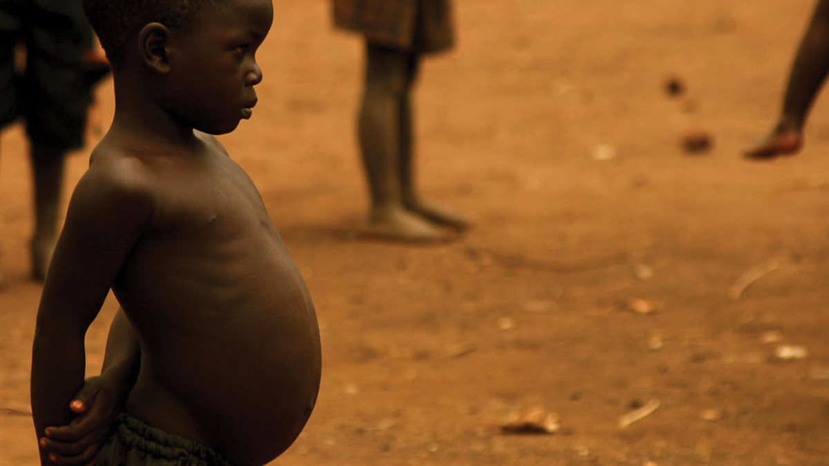 Голову в голоде живот в. Квашиоркор у детей Африки. Квашиоркор у африканских детей.