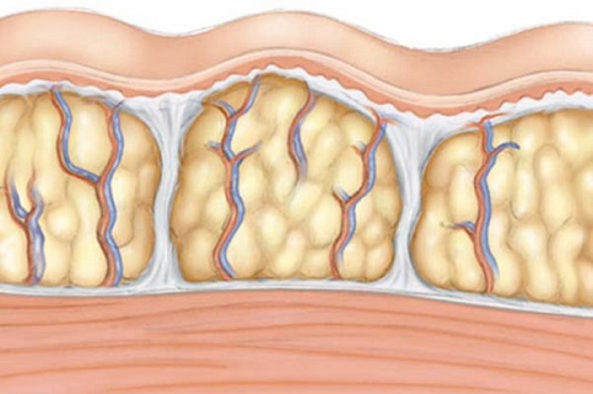 Инфильтрация жировой клетчатки. Целлюлит подкожный жир. Жировая прослойка под кожей.