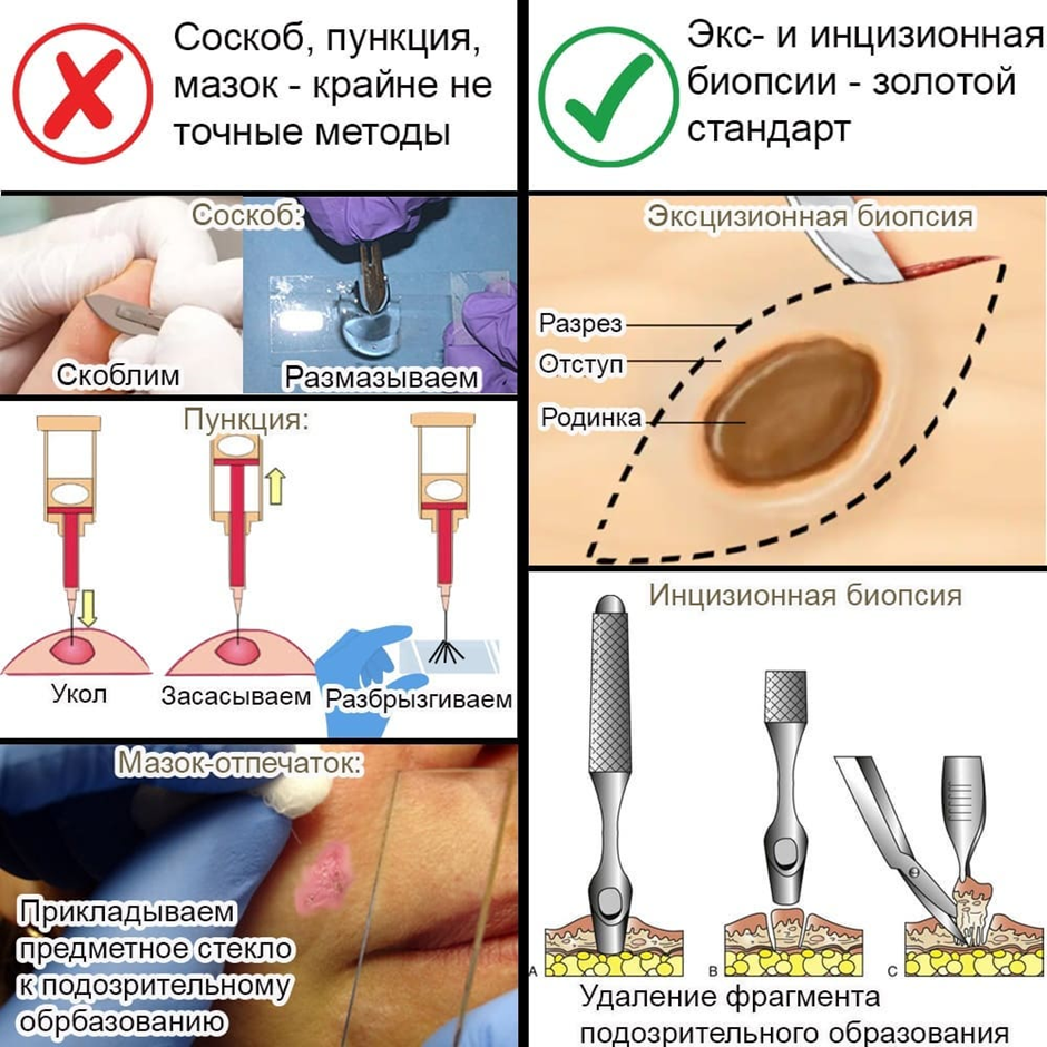 Инцизионная эксцизионная биопсия презентация