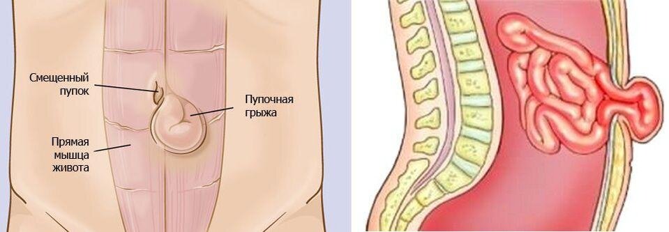 Так выглядит пупочная грыжа.