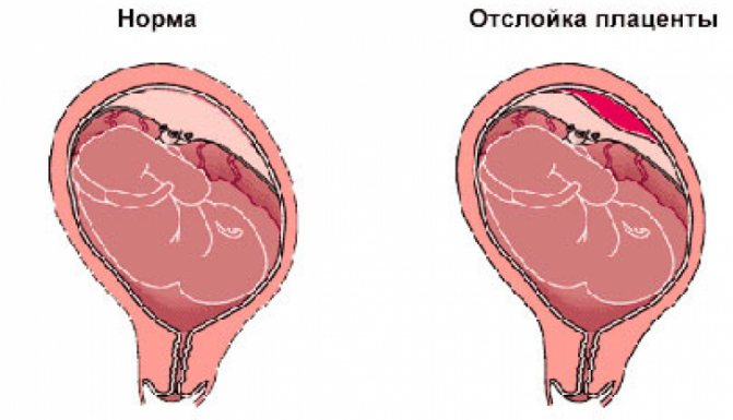 Гематома при беременности