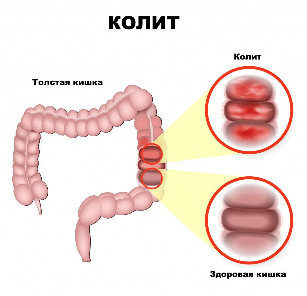 Язвенный колит — главное о заболевании | Evolutis Clinic | Дзен