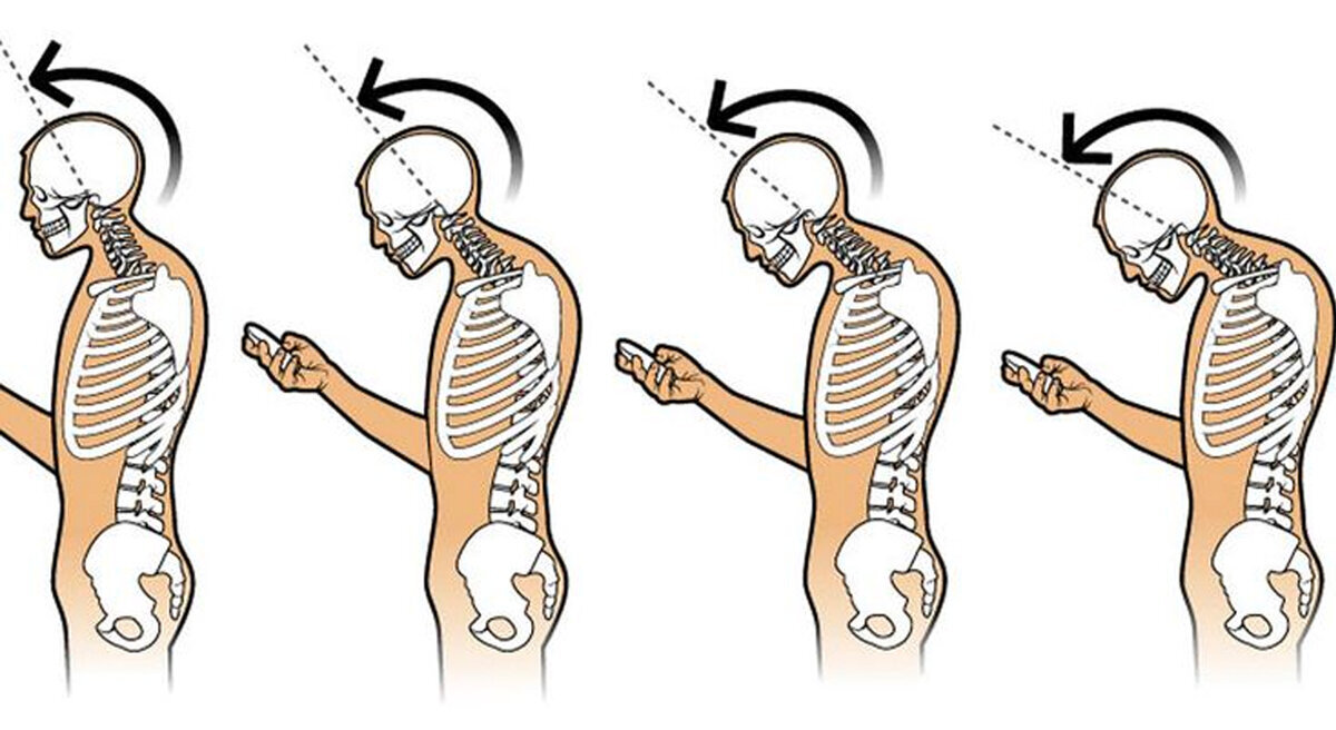 Sms шея. Синдром компьютерной шеи. Сутулость скелет. Текстовая шея. Компьютерная шея искривление позвоночника.