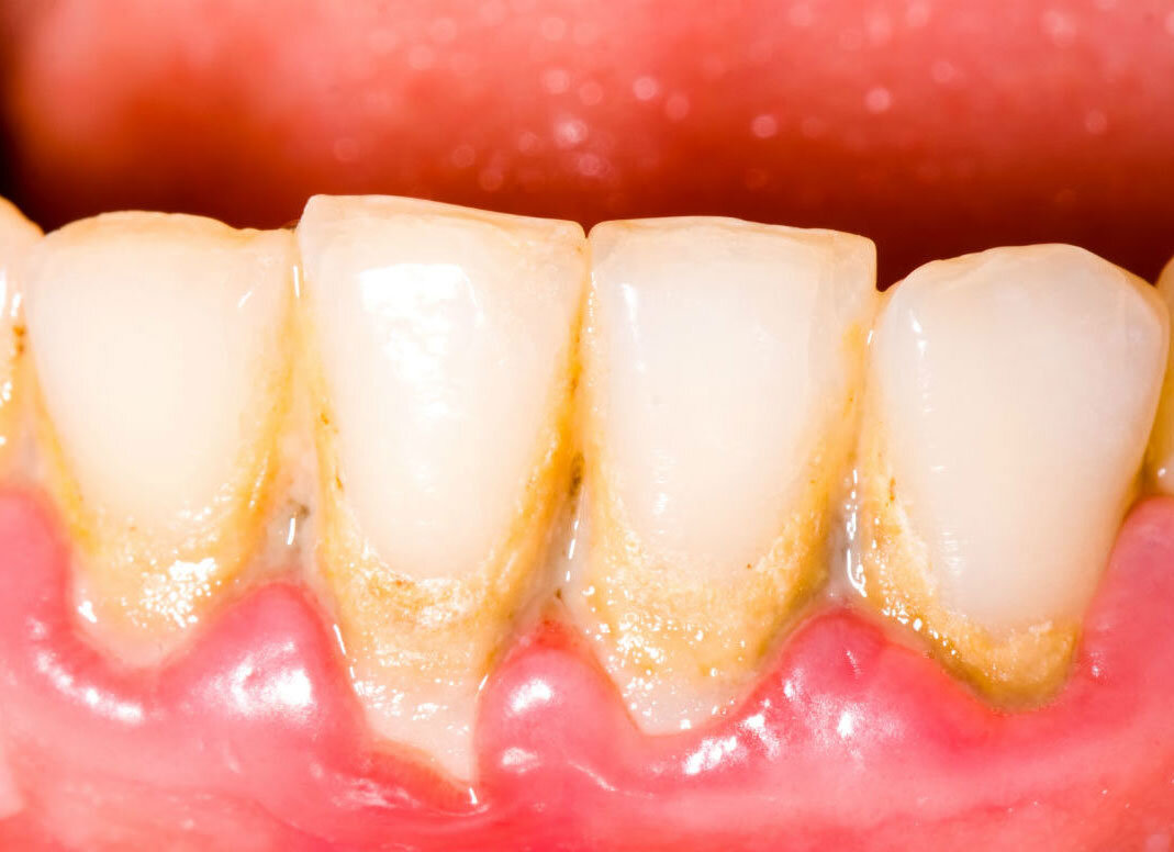 Зубной камень