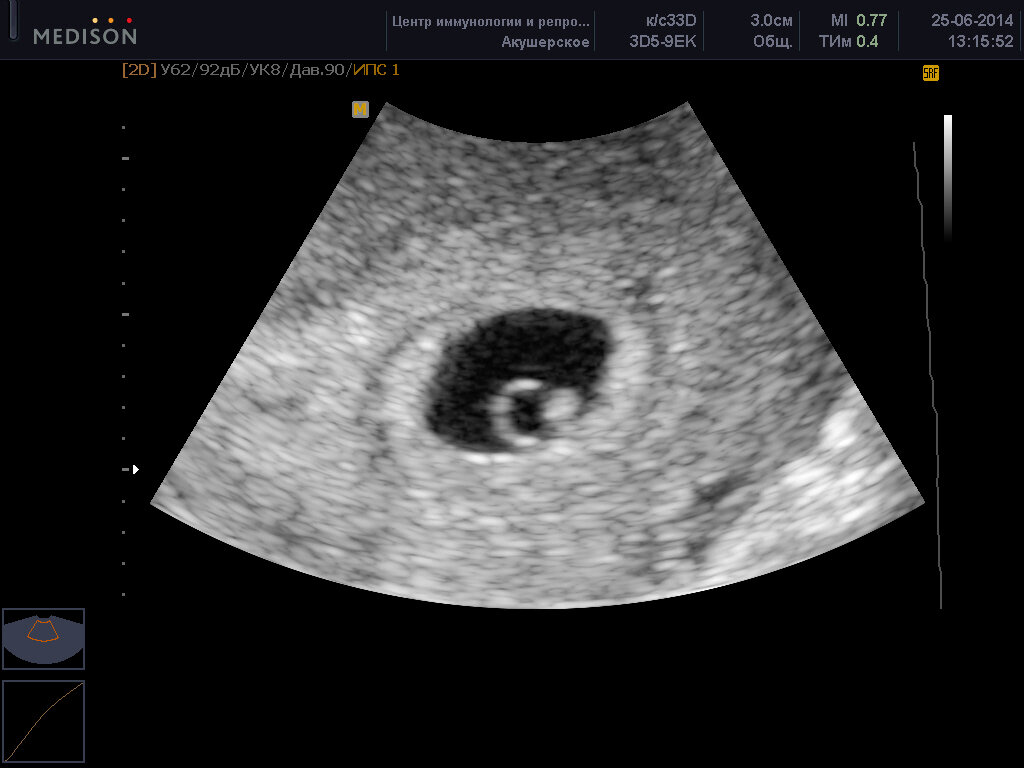 https://www.cironline.ru/services/ultrasound/pregnancy/photo/img/5-6-week-0002.jpg
