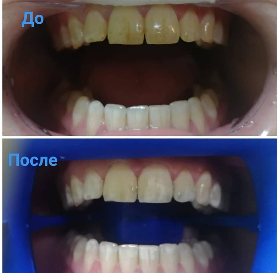 Лазерное отбеливание зубов фото до и после