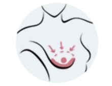     Увеличение объема, отечность молочной железы 