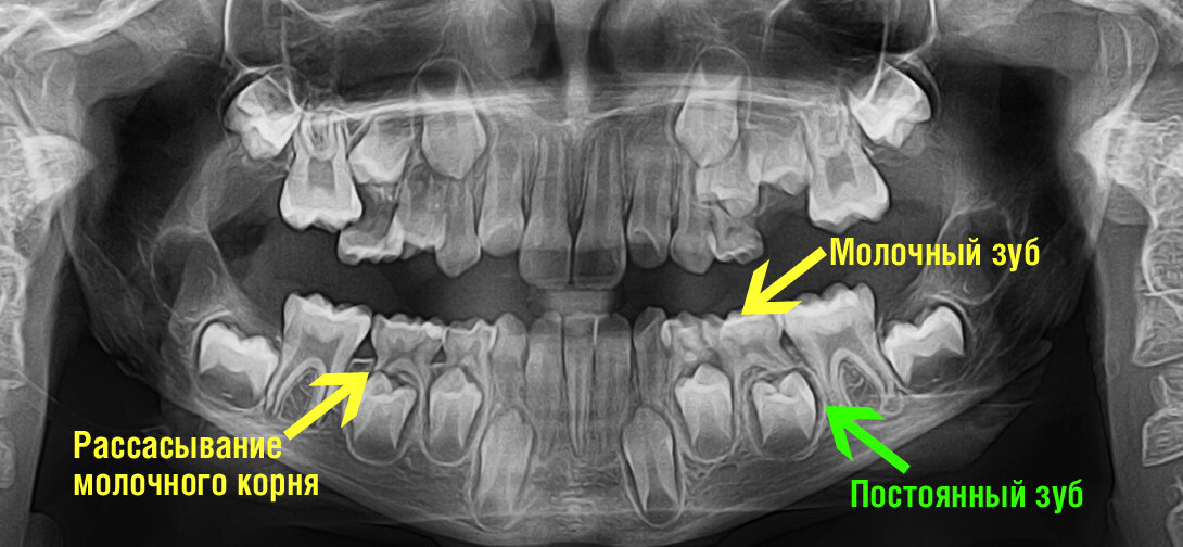 В каких случаях нужно удалять молочные зубы ребёнку