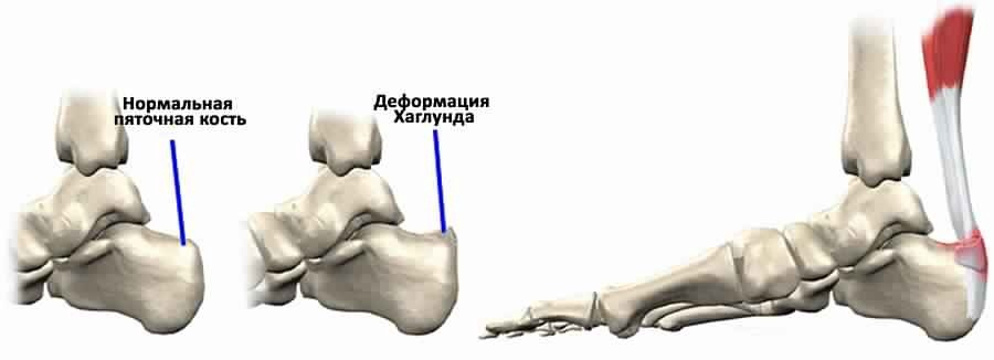 Остеофит (костный нарост), который появляется на задней части пяточной кости немного выше места прикрепления ахиллова сухожилия, носит название деформация Хаглунда, по имени автора, впервые описавшего