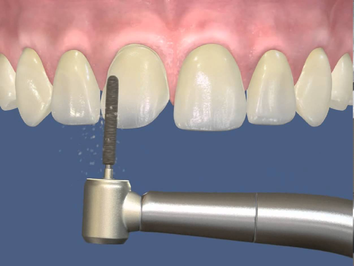 Препарирование зуба. Металлокомпозитная коронка препарирование. Цельнокерамическая коронка препарирование. Препарирование моляра под коронку. Препарирование зуба под штампованную коронку.