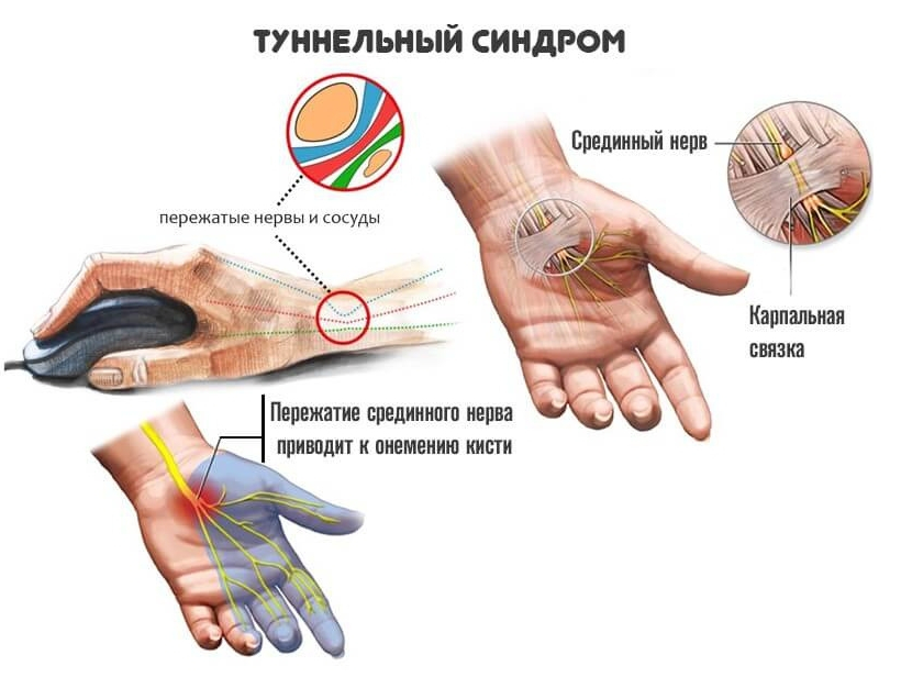 Как будто онемели руки. . Кистевой туннельный синдром (карпальный синдром). Карпальный нерв запястья руки. Амилоидоз запястье туннельный синдром. Туннельный синдром кисти тейпирование.