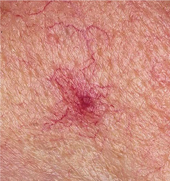 телеангиоэктазии