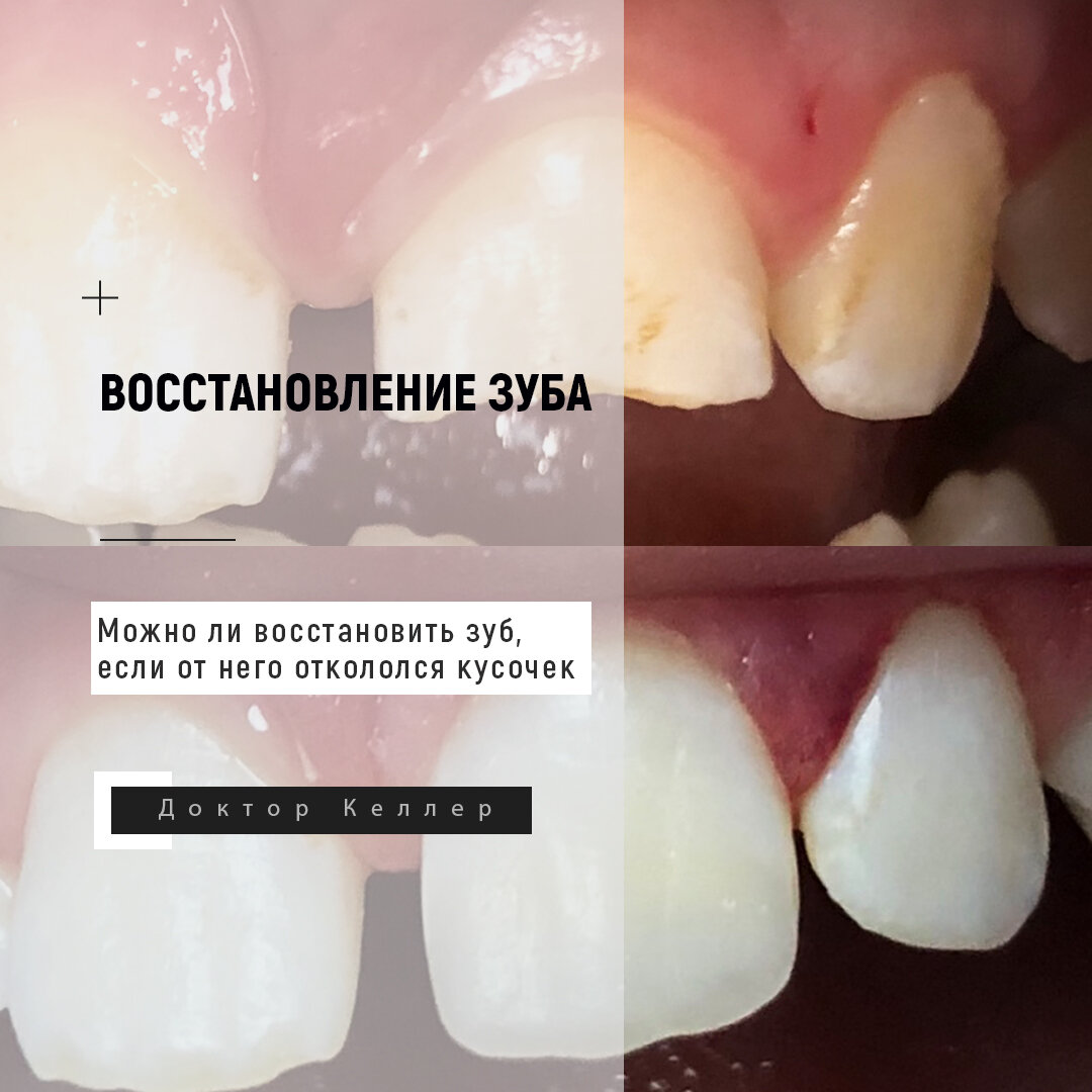 Откололся кусочек зуба