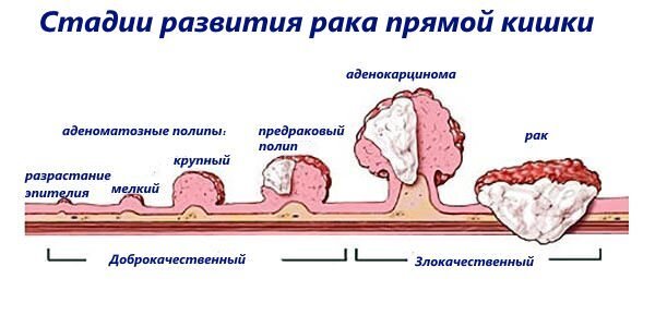 Рак прямой кишки: симптомы, стадии, лечение, прогноз