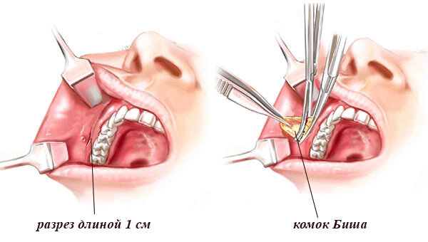 Процесс удаления комков Биша