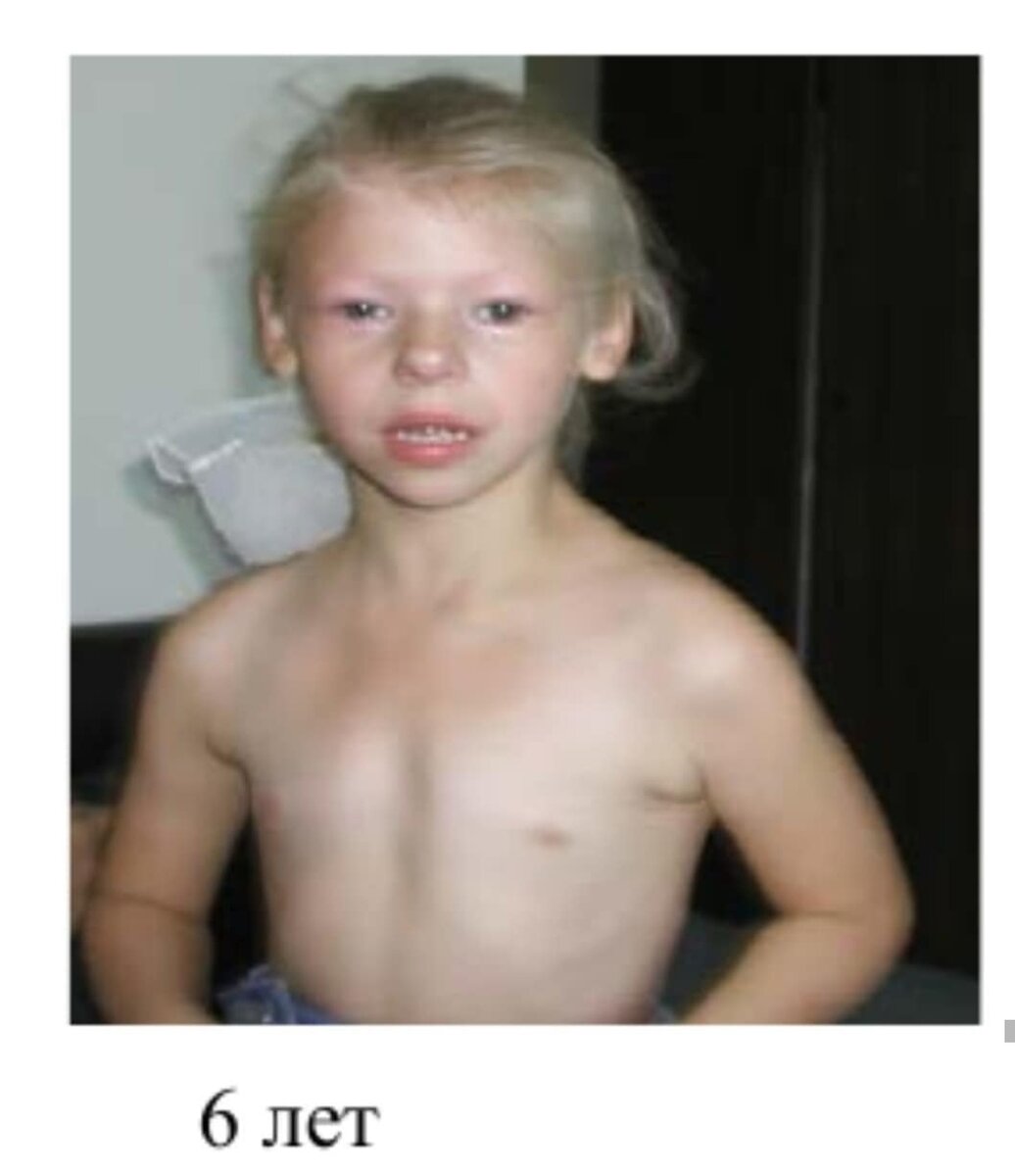синдром рассела сильвера фото детей