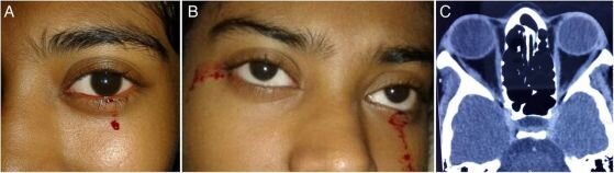 Кровавые слезы текут из глаз девушки (A) и (B) и нормальное обнаружение при компьютерной томографии орбит и околоносовых пазух.