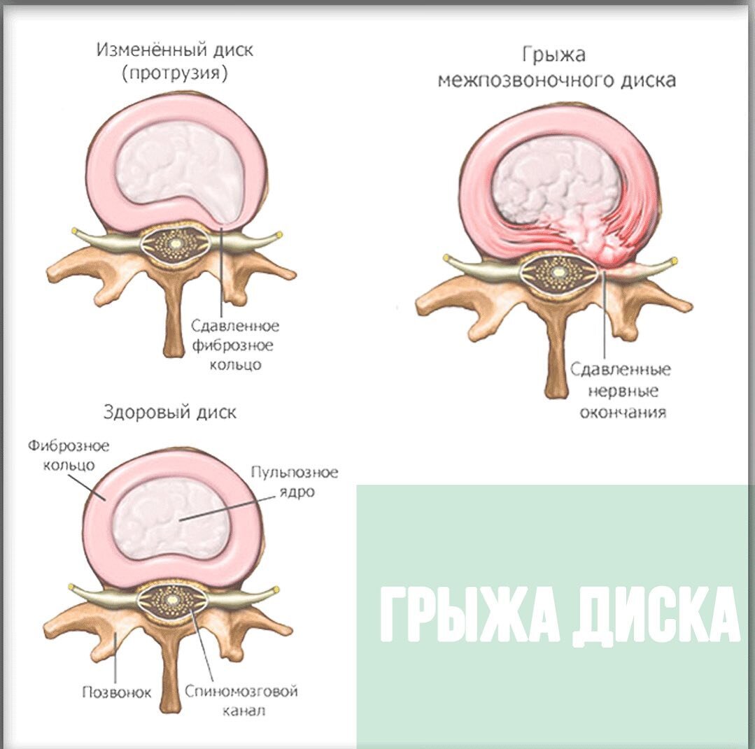 Грыжа диска | Андрей Светашов | Дзен