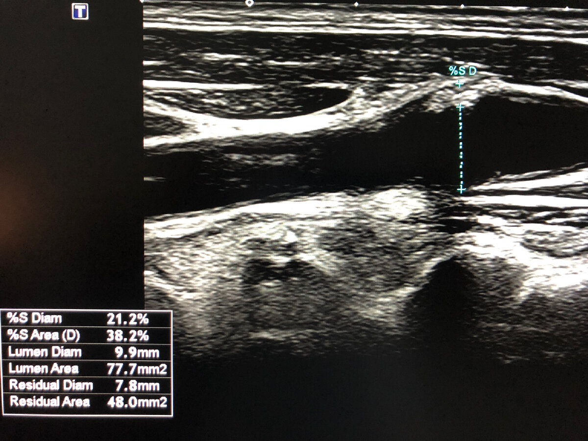 Что значит атеросклероз брахиоцефальных артерий. Атеросклероз сосудов брахиоцефальных артерий. Стенозирующий атеросклероз брахиоцефальных артерий. ЦДК брахиоцефальных сосудов. УЗИ бца.