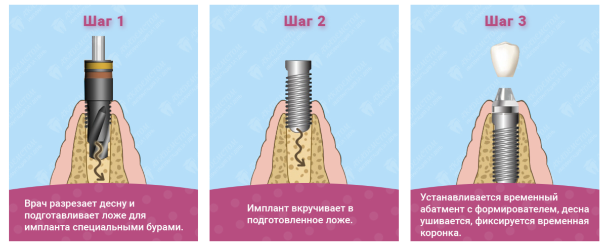 Установка имплантата с немедленной нагрузкой. Фото с сайта https://akademstom.ru/implantacija-zubov/