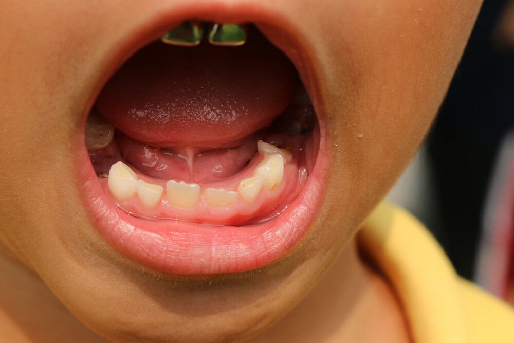 Коронки – специальные “колпачки”, в точности повторяющие анатомию зуба ребенка. Устанавливаются для избежания появления стоматологических, логопедических и пищеварительных проблем. 
