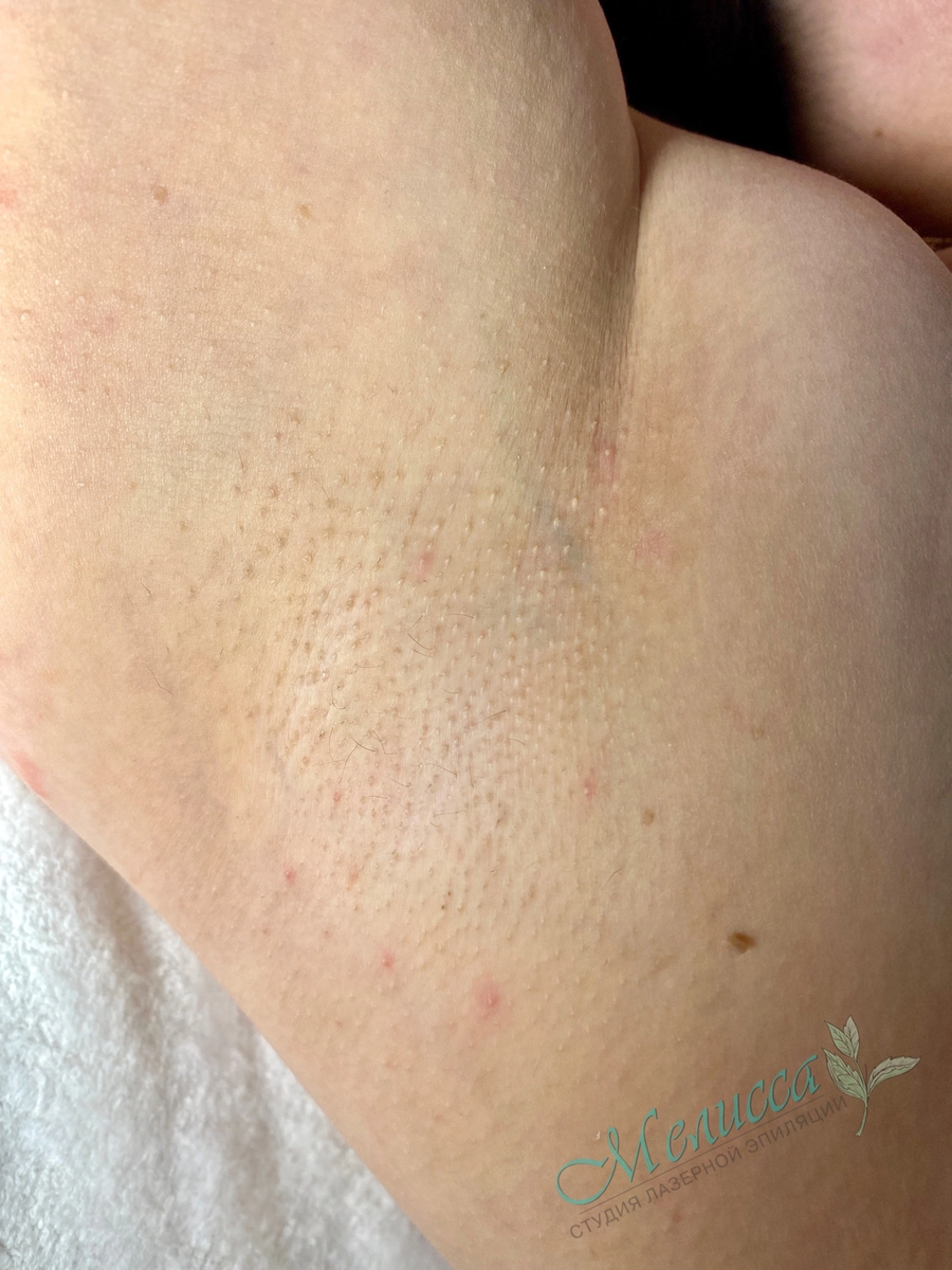 Лазерная эпиляция в Чайковском 