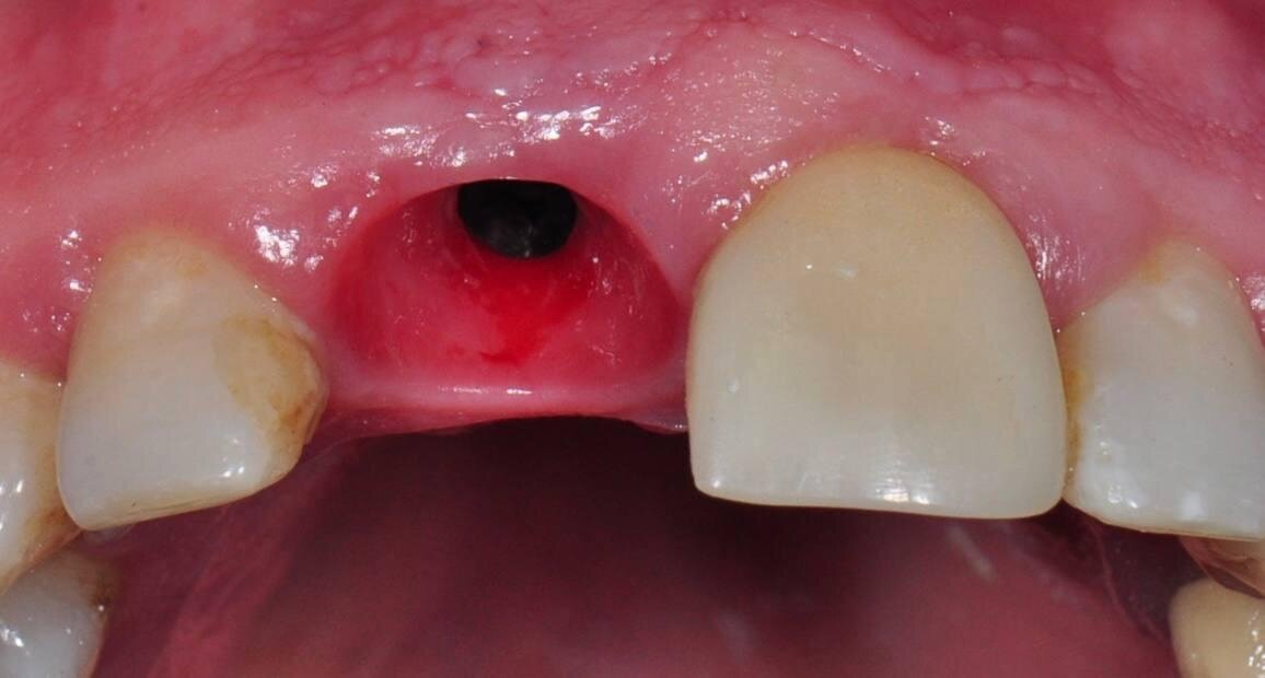 Фрезы используются в строгой последовательности, и финальное сверло бывает чуть уже диаметра имплантата. С помощью фрез врач подготавливает костное ложе для нового зуба.