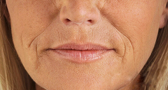 Носогубные складки без отека