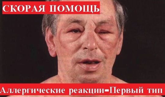 Внимание!Вся информация в видео только для ознакомительных целей!При возникновении каких либо симптомов вызывается скорая медицинская помощь! 