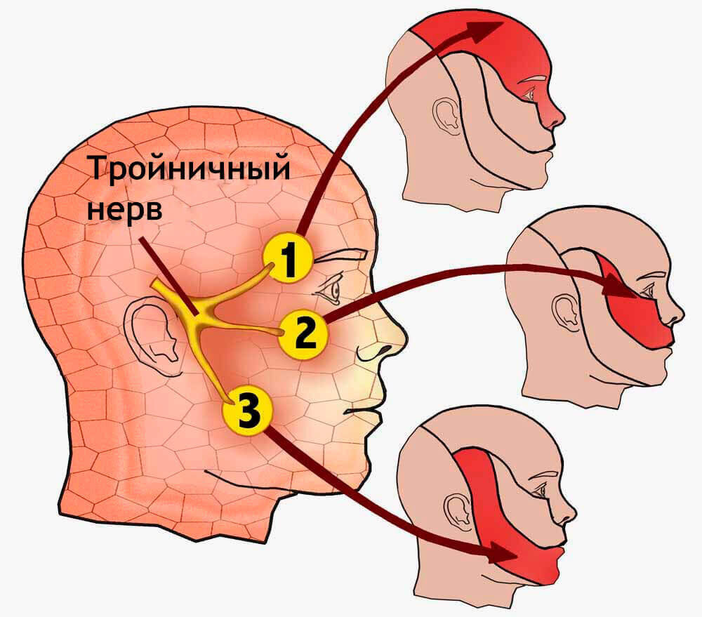 При воспалении веточек тройничного нерва происходит поражение определенного участка лица