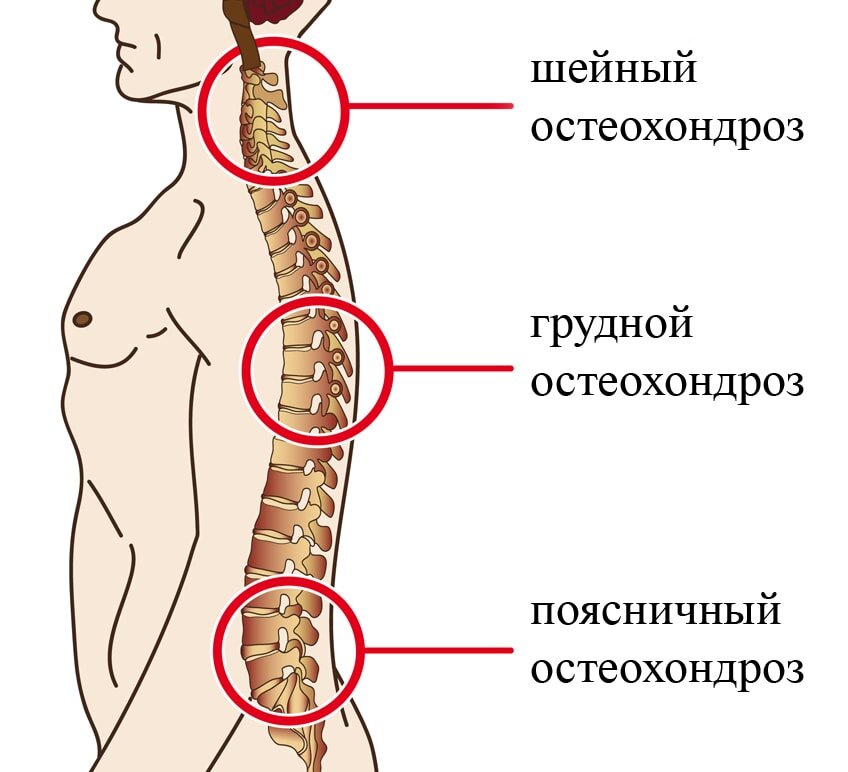 Онемение конечностей при остеохондрозе