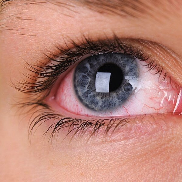 Всеми любимый синдром сухого глаза | Твой домашний офтальмолог | Дзен