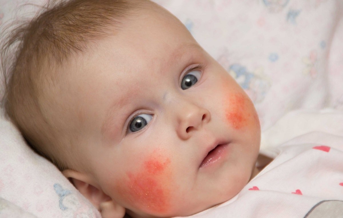 аллергия у ребенка 2 года фото