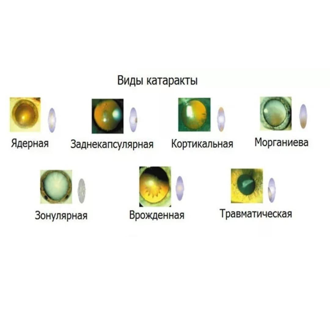 Факосклероз хрусталика глаза что