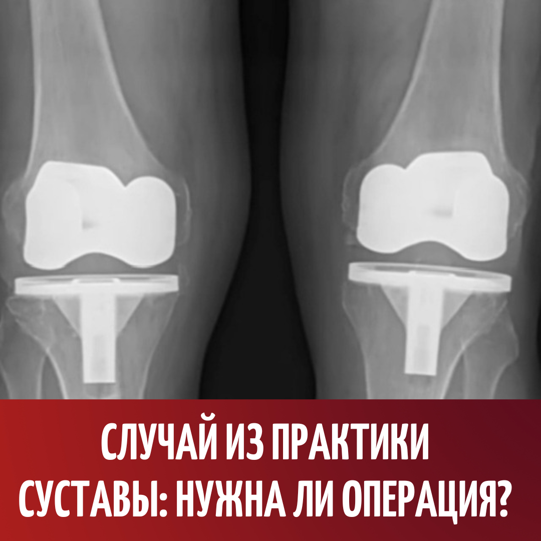 Как жить с артрозом колена. 6 упражнений, которые необходимо делать человеку с артрозом тазобедре. Артроз Коленного Сустава Компрессы С Димексидом – Telegraph Стадии гонартроза
