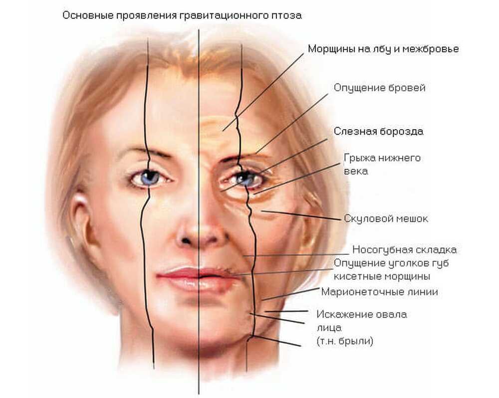 Тейпирование кисетных морщин над верхней губой схема