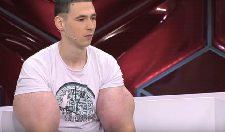 Кирилл Терешин прославился на всю страну за счет огромных синтетических мышц на руках, опасных для его жизни.-2