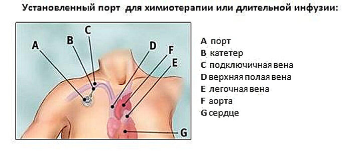 Как выглядит порт система для химиотерапии фото Порт для химиотерапии что это такое