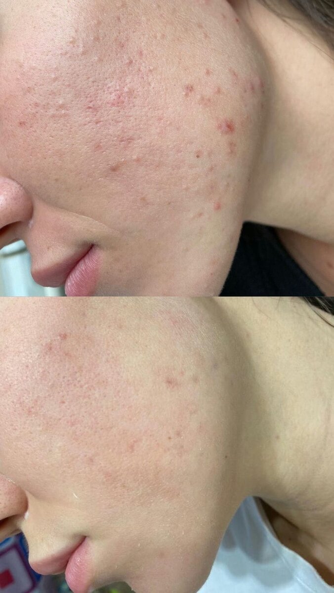 Фото сверху до процедуры ультразвуковой чистки, снизу фото - результат после процедуры.