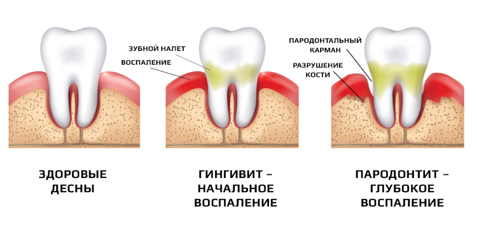 Удаление зубов - Dinvrach