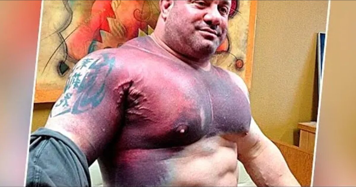 Счастливый обладатель порванной грудной мышцы